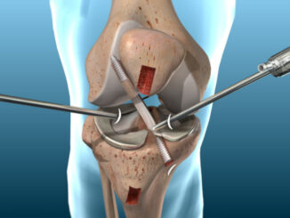 Bài tập hỗ trợ sau phẫu thuật ACL