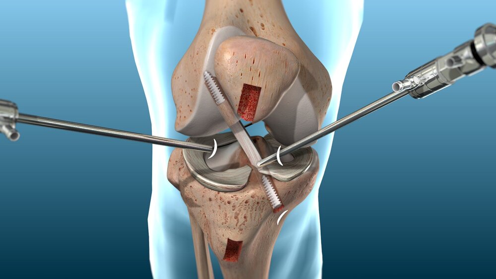 Các giai đoạn phục hồi và bài tập tương ứng sau phẫu thuật ACL