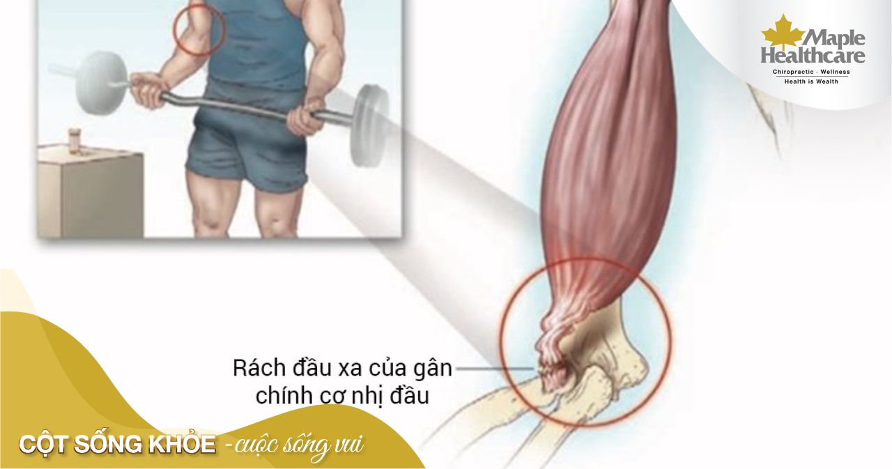 Các giai đoạn và dấu hiệu hồi phục sau rách cơ